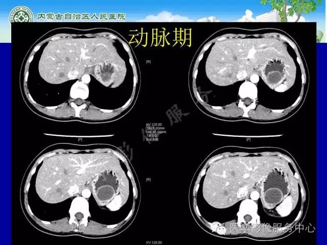 【罕见病例】全球仅22例的深在性囊性胃炎1例CT影像