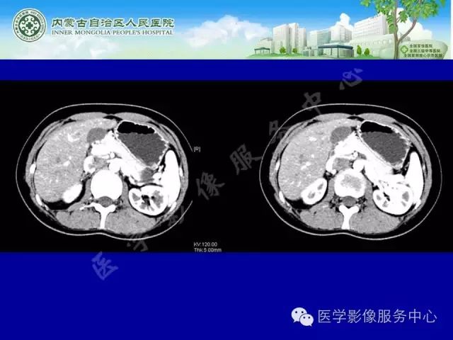 【罕见病例】全球仅22例的深在性囊性胃炎1例CT影像