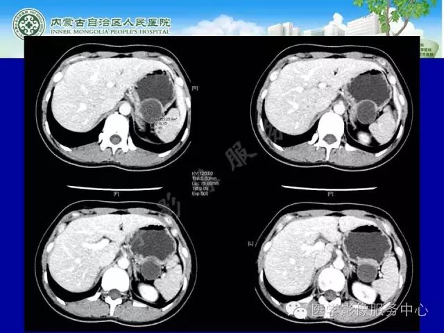 【罕见病例】全球仅22例的深在性囊性胃炎1例CT影像