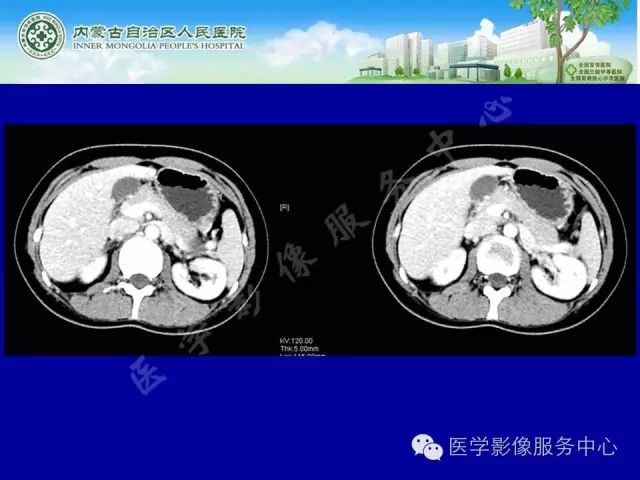 【罕见病例】全球仅22例的深在性囊性胃炎1例CT影像