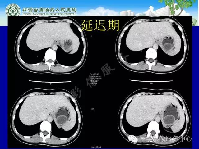 【罕见病例】全球仅22例的深在性囊性胃炎1例CT影像