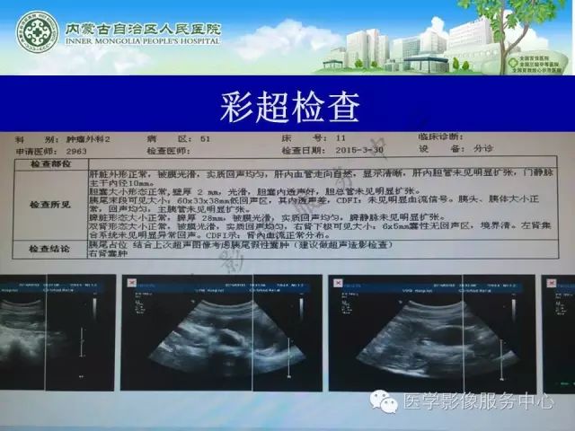 【罕见病例】全球仅22例的深在性囊性胃炎1例CT影像