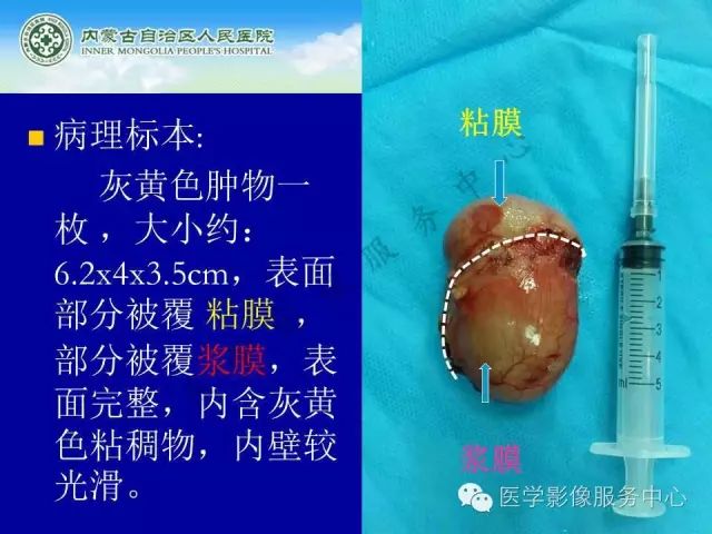 【罕见病例】全球仅22例的深在性囊性胃炎1例CT影像