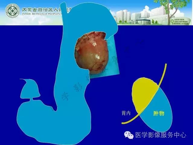 【罕见病例】全球仅22例的深在性囊性胃炎1例CT影像