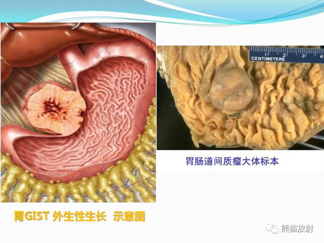 【病例】胃肠道间质瘤GIST一例CT影像诊断
