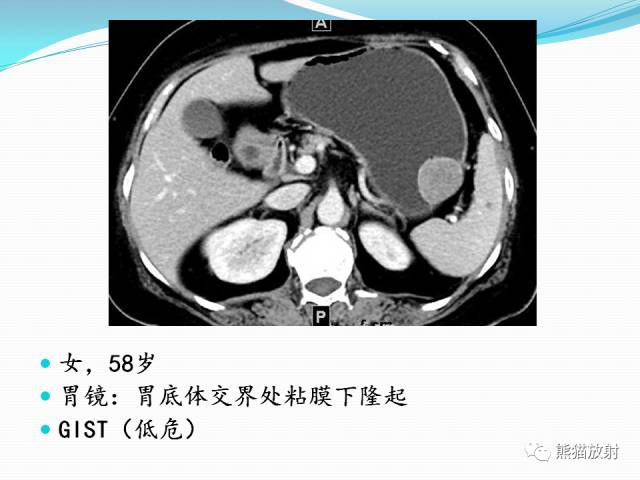 【病例】胃肠道间质瘤GIST一例CT影像诊断