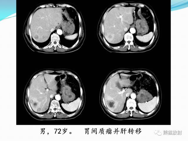 【病例】胃肠道间质瘤GIST一例CT影像诊断
