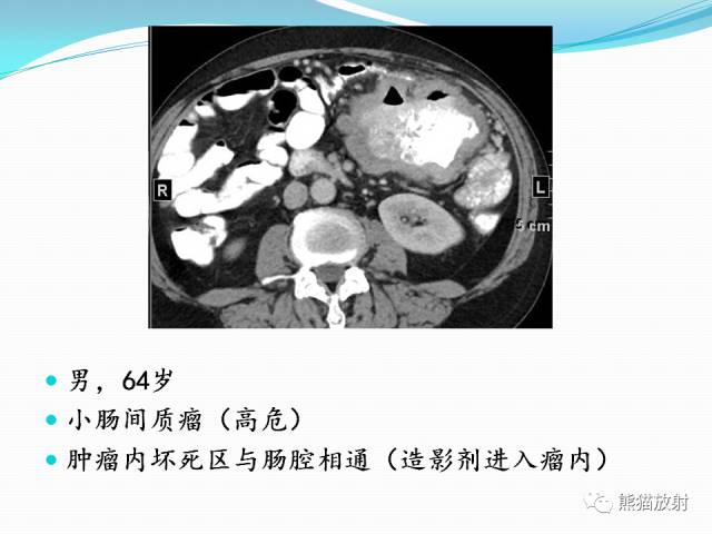 【病例】胃肠道间质瘤GIST一例CT影像诊断