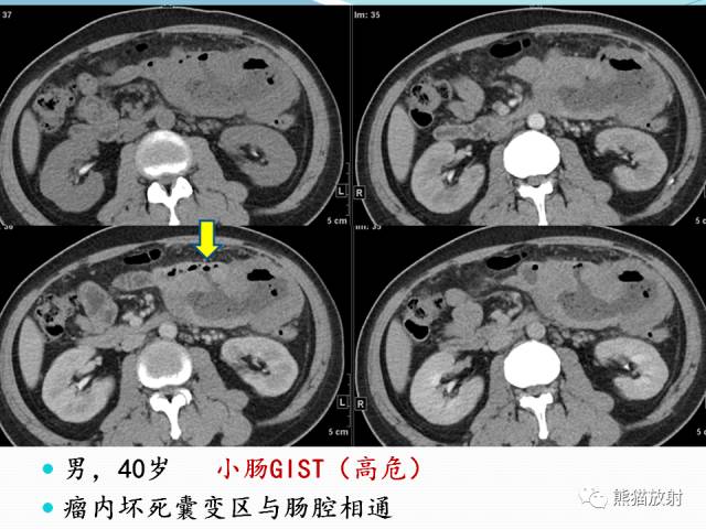 【病例】胃肠道间质瘤GIST一例CT影像诊断