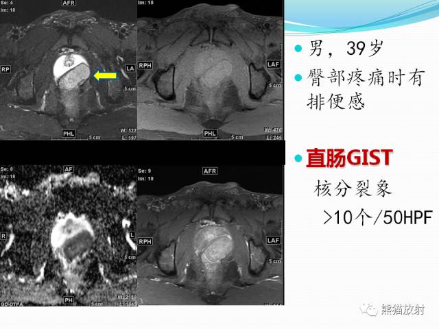 【病例】胃肠道间质瘤GIST一例CT影像诊断