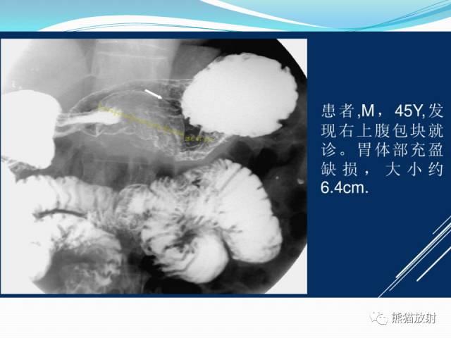 【病例】胃肠道间质瘤GIST一例CT影像诊断