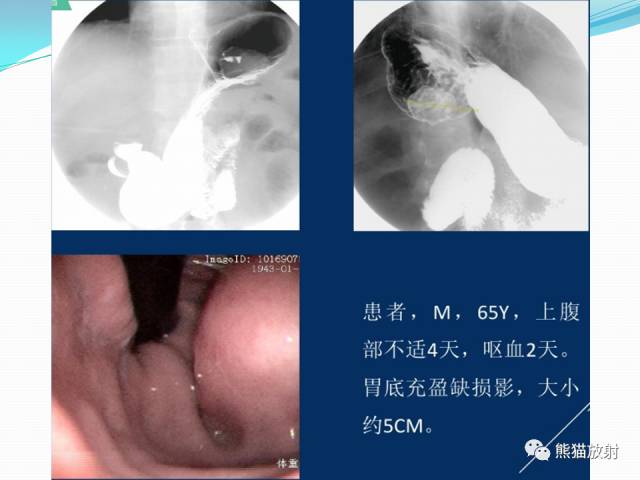 【病例】胃肠道间质瘤GIST一例CT影像诊断