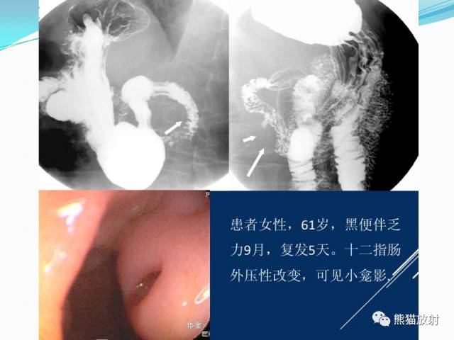 【病例】胃肠道间质瘤GIST一例CT影像诊断