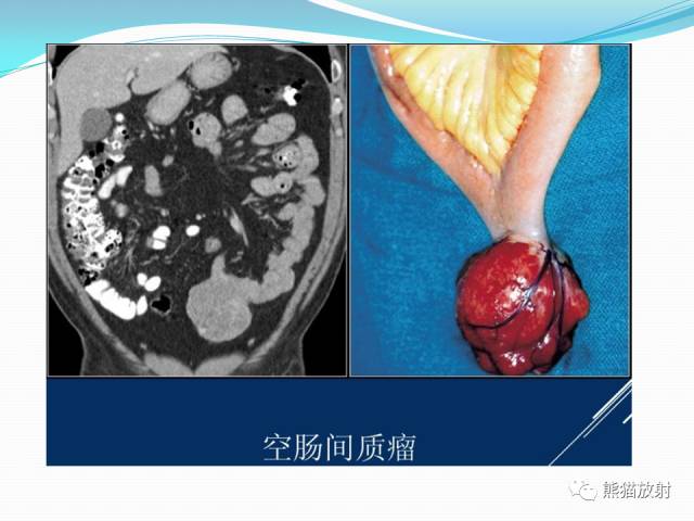 【病例】胃肠道间质瘤GIST一例CT影像诊断