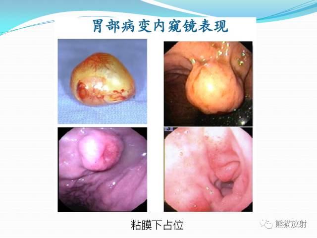 【病例】胃肠道间质瘤GIST一例CT影像诊断