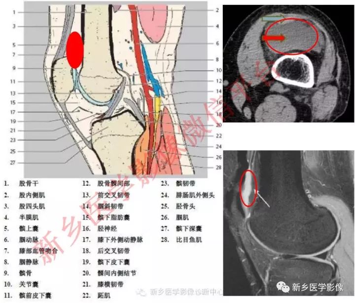 膝关节的15个滑囊解剖