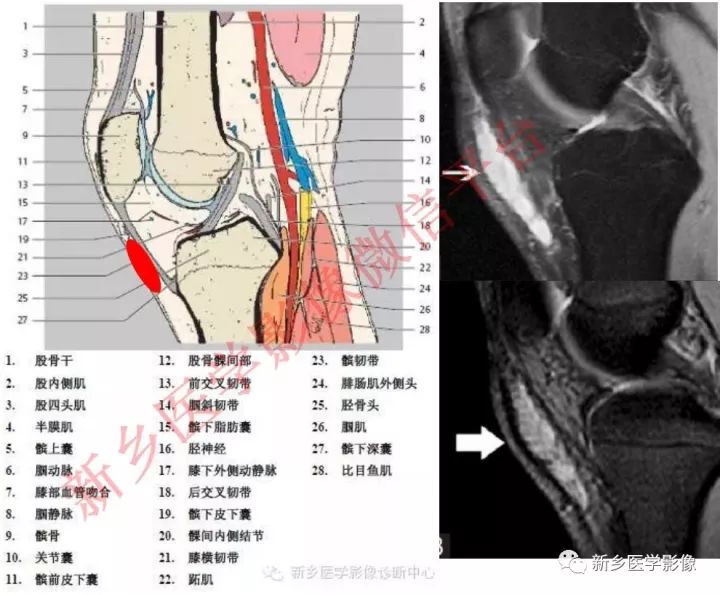膝关节的15个滑囊解剖