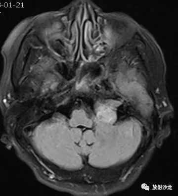【病例】听神经瘤1例MR影像表现