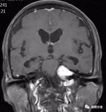 【病例】听神经瘤1例MR影像表现