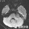 【病例】听神经瘤1例MR影像表现