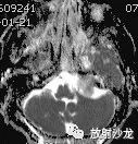【病例】听神经瘤1例MR影像表现