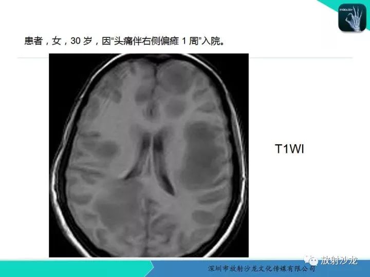 【病例】肿瘤样炎性脱髓鞘病1例MR影像表现