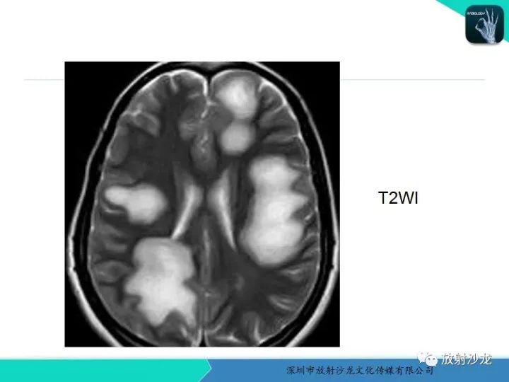 【病例】肿瘤样炎性脱髓鞘病1例MR影像表现