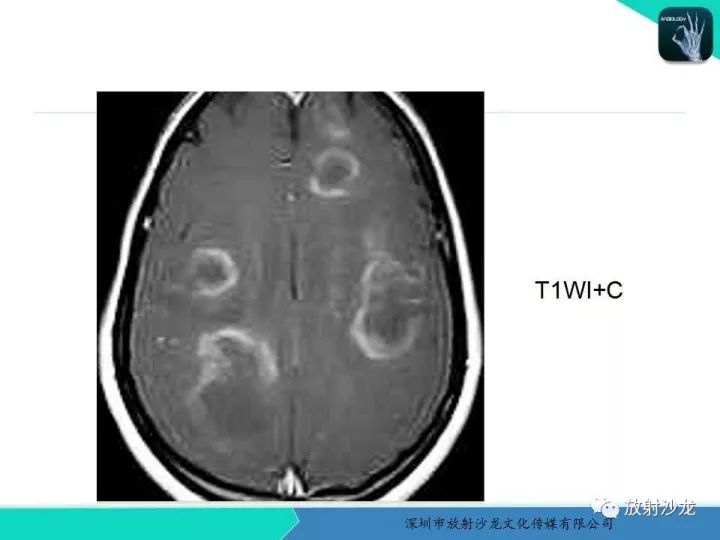 【病例】肿瘤样炎性脱髓鞘病1例MR影像表现