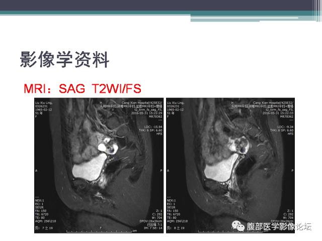 【病例】卵巢甲状腺肿1例MR
