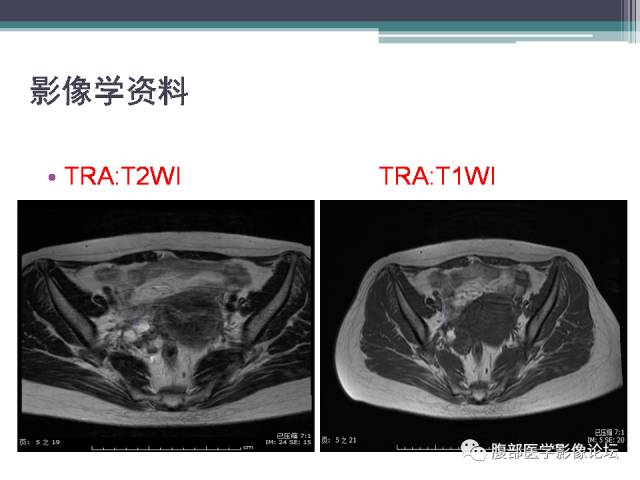 【病例】卵巢甲状腺肿1例MR