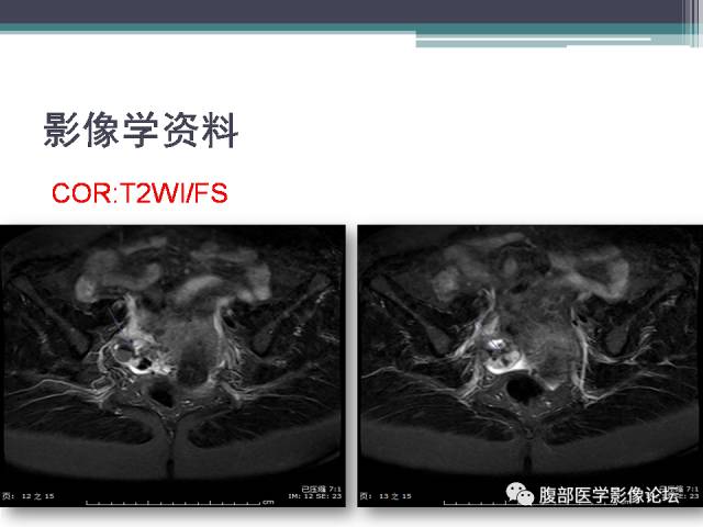 【病例】卵巢甲状腺肿1例MR