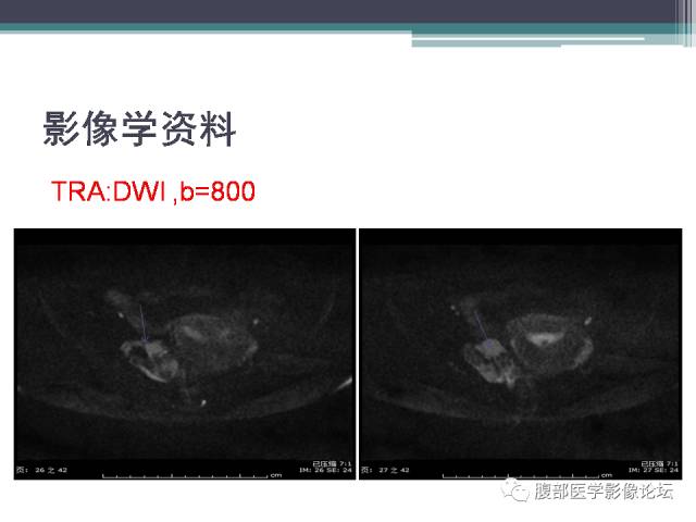 【病例】卵巢甲状腺肿1例MR