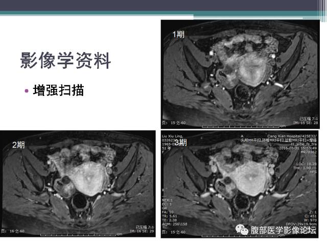 【病例】卵巢甲状腺肿1例MR