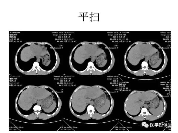 【病例】原发性肝癌1例CT影像表现