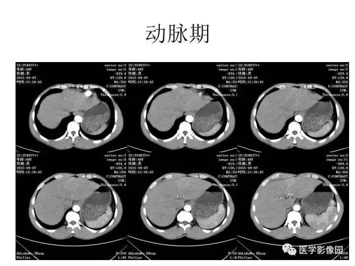 【病例】原发性肝癌1例CT影像表现