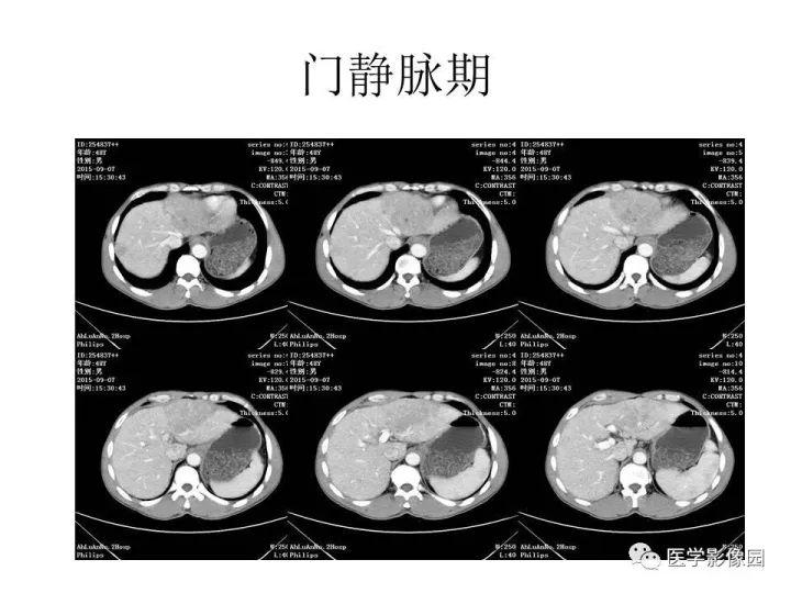 【病例】原发性肝癌1例CT影像表现