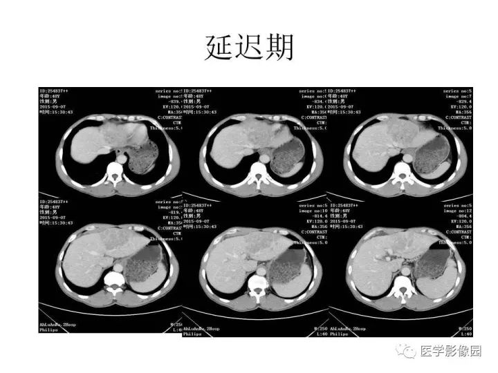 【病例】原发性肝癌1例CT影像表现