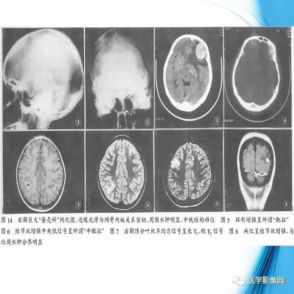 【PPT】颅内结核MRI影像表现及鉴别诊断