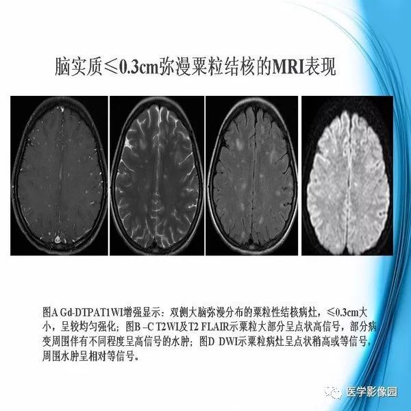 【PPT】颅内结核MRI影像表现及鉴别诊断