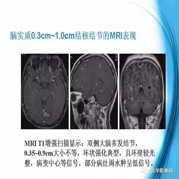 【PPT】颅内结核MRI影像表现及鉴别诊断