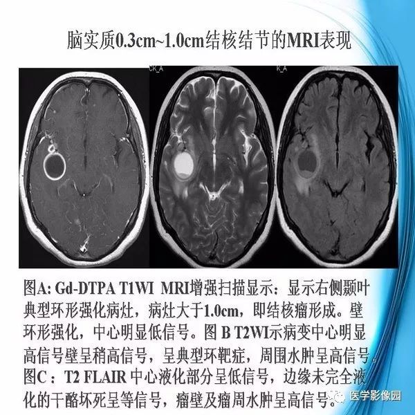 【PPT】颅内结核MRI影像表现及鉴别诊断