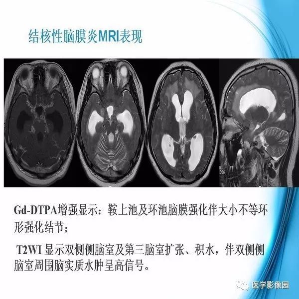 【PPT】颅内结核MRI影像表现及鉴别诊断