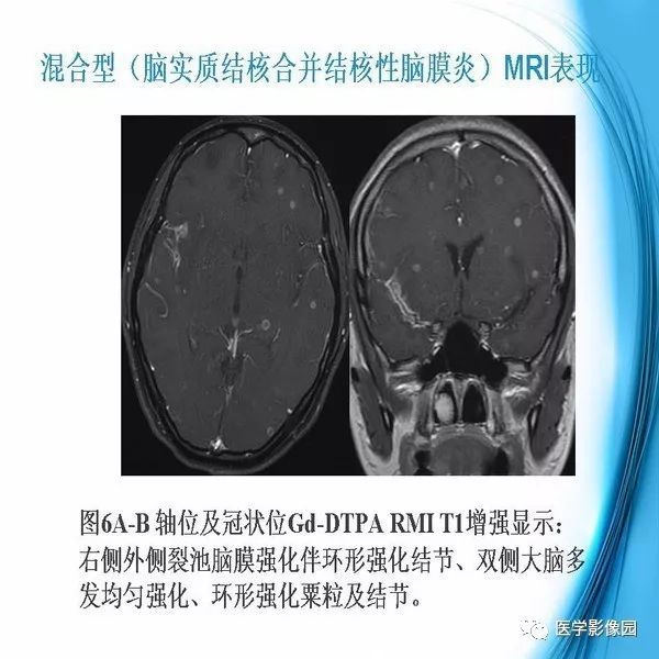 【PPT】颅内结核MRI影像表现及鉴别诊断
