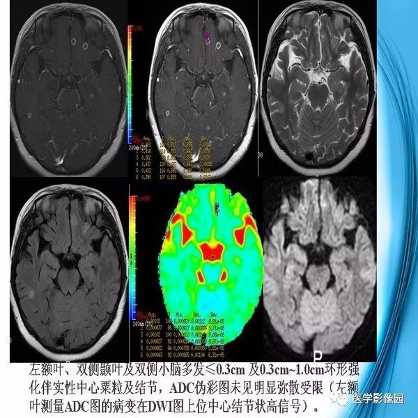 【PPT】颅内结核MRI影像表现及鉴别诊断