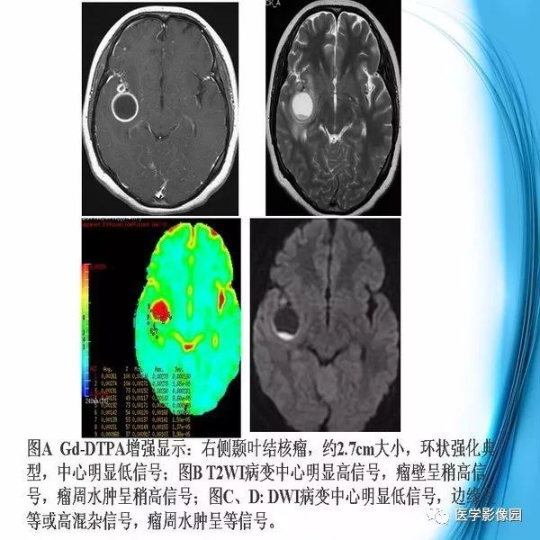 【PPT】颅内结核MRI影像表现及鉴别诊断