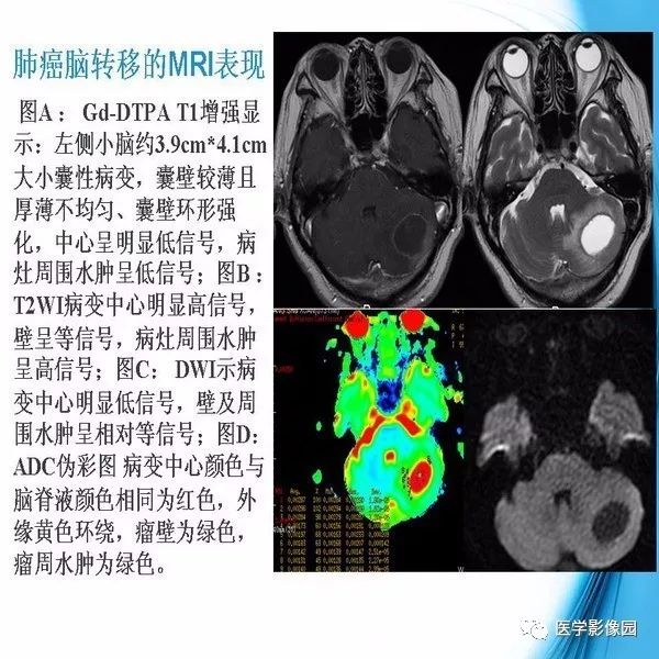 【PPT】颅内结核MRI影像表现及鉴别诊断