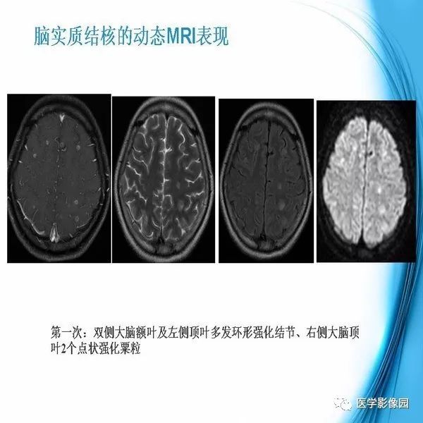 【PPT】颅内结核MRI影像表现及鉴别诊断