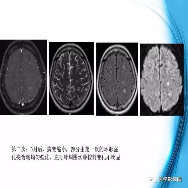 【PPT】颅内结核MRI影像表现及鉴别诊断