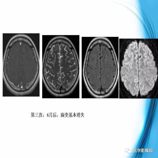 【PPT】颅内结核MRI影像表现及鉴别诊断