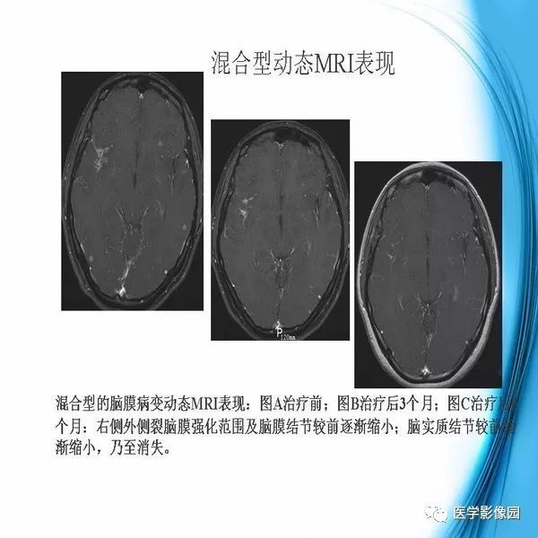 【PPT】颅内结核MRI影像表现及鉴别诊断